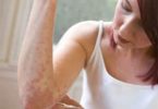 Kontakt Dermatitin Nedenleri, Belirtileri ve Tedavisi