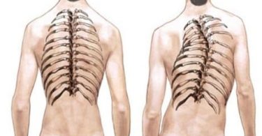 Ankilozan Spondilit Nedir? Nedenleri, Belirtileri ve Tedavisi