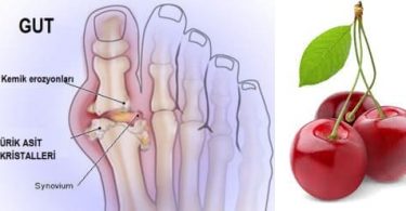 Gut Hastalığı Nedir? Belirtileri, Nedenleri, Tanı ve Tedavi