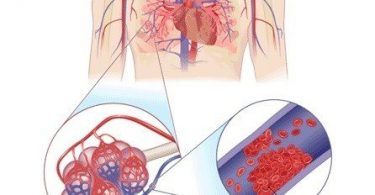 Emboli Nedir? Çeşitleri ve Tedavisi