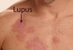 Lupus Hastalığı Nedir? Nedenleri, Tanı ve Tedavisi